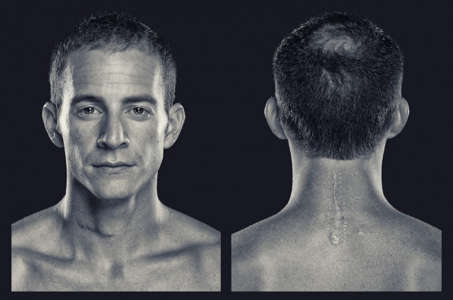 picture of man looking at camera and back showing off scar from spinal surgery