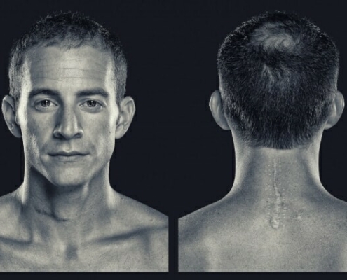 spinal surgery patient
